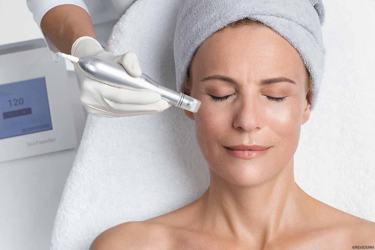 microneedling